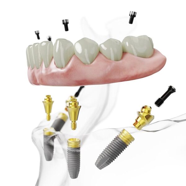 All-on-4 TiUltra_hero 1_lower jaw NobelParallel 1500x1500 copy